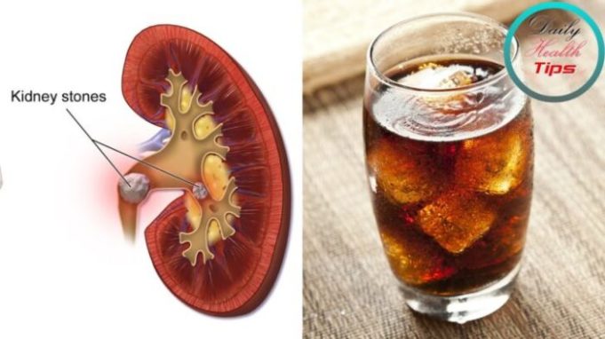 Can diet soda cause kidney stones